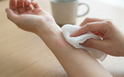 Brûlure laser : reconnaître les signes et agir en urgence