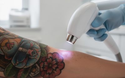 épilation laser et tatouage : comment préserver son tatouage tout en éliminant les poils